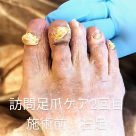 訪問足爪ケア２回目の画像