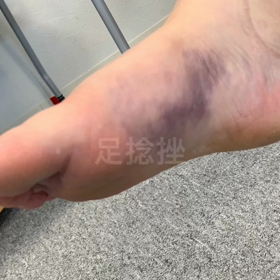 足捻挫をしたけどすぐに歩けるようになる！の画像