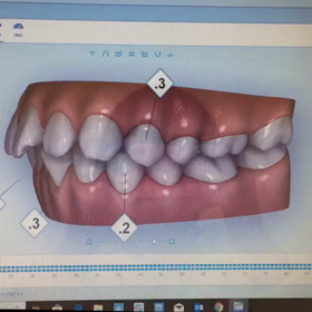 インビザラインデビュー！〜クリンチェック編〜の画像