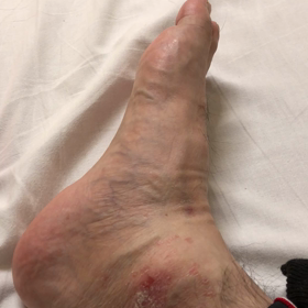 感動 麻痺した右足かかとが動いた日の画像