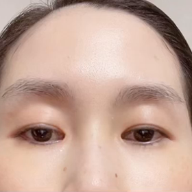 今回はバニーラインも忘れずボトックスしましたの画像