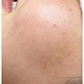 頬のつまりは、くすみの原因の画像