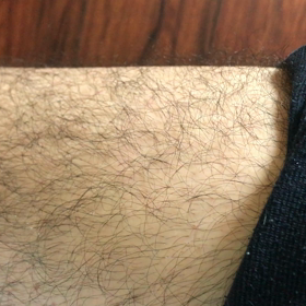 またまた汚い右足太もものピクつき（閲覧注意）の画像