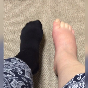 アキレス腱断裂 術後65日+装具43日目 >>> 装具卒業...？の画像