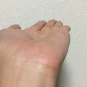 肘部管症候群の手術の為10日ほど休業しますの画像