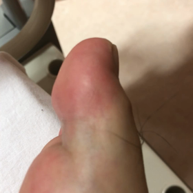 感動 麻痺した右足親指が動いた日の画像