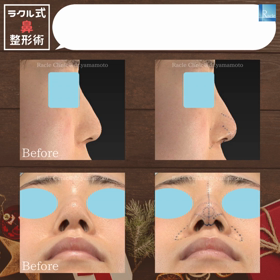 鼻の施術症例をご紹介の画像