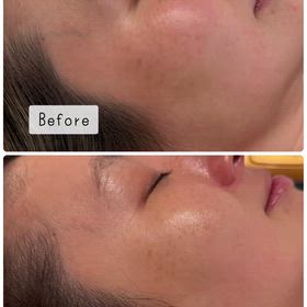 ♡お肌に優しいピーリング♡の画像