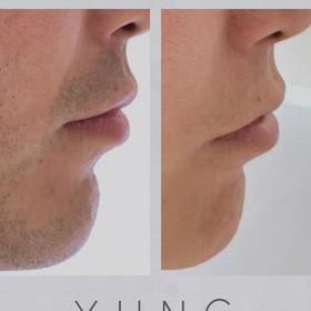 別人級の脱毛効果の画像