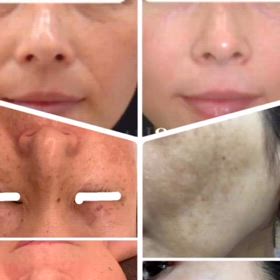 短期で肝斑改善の画像