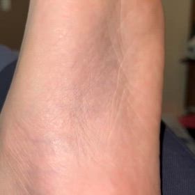 背中、太もも、足裏のピクつきの画像