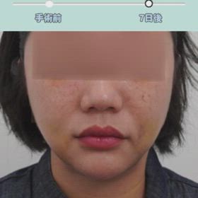 顔脂肪吸引、バッカルファット除去、糸リフト症例動画の画像