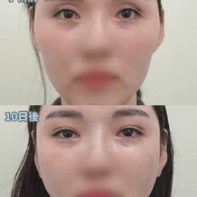 瞼の脂肪移植、頬の脂肪移植症例動画の画像