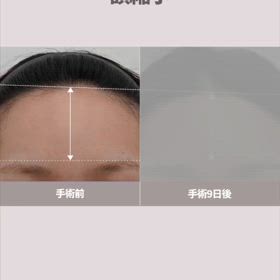コユ整形外科の額縮小手術（ビフォアフショート動画付き）の画像