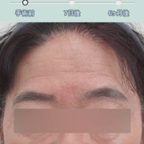 額拳上、眉下切開リフト、下眼瞼 レポ✎の画像