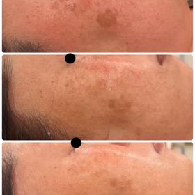 アトピーから肝斑改善の画像