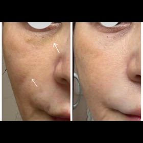 シミたるみ改善の画像