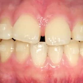 歯科矯正の治療例のご紹介の画像