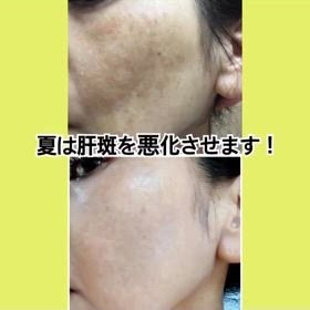 なつは肝斑を悪化させますの画像