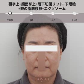 額挙上、顔面挙上、眉下切開、下眼瞼、瞼の脂肪移植、エクソソーム✎の画像
