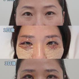 眉下切開リフト、下眼瞼、目の下脂肪移植症例動画の画像