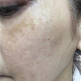 間違ったケアが肝斑を悪化の画像