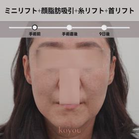 ミニリフト、顔脂肪吸引、糸リフト、首リフト症例動画の画像