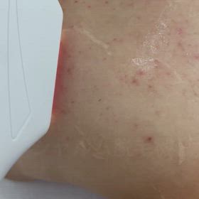 業務用脱毛機の画像