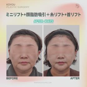 ミニリフト、糸リフト、顔脂肪吸引、首リフト症例動画の画像