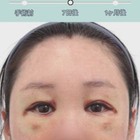 額挙上(ボーントンネリング/3ポイント切開)+目頭切開+タレ目形成症例動画の画像