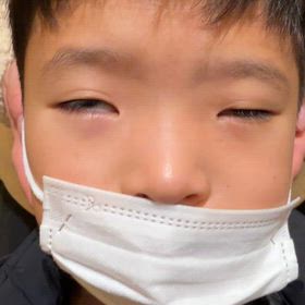 他院で治らない小児のブローアウト骨折がまた来ましたの画像