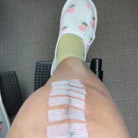 人工膝関節置換術～②入院13日目の画像