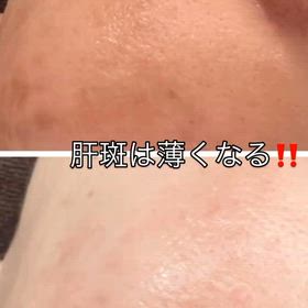 肝斑薄くの画像