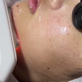 業務用脱毛機の画像