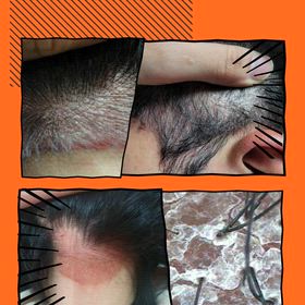 頭皮乾癬とは？の画像