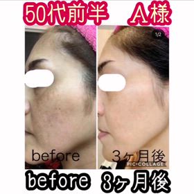 肝斑シミ3ヶ月の画像