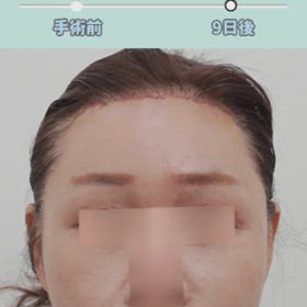 額縮小+額挙上症例動画の画像