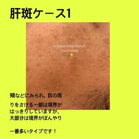 肝斑にも種類がありますの画像