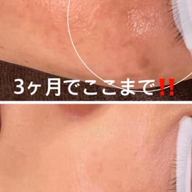 肝斑改善の画像