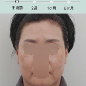 額挙上、その他手術症例動画の画像