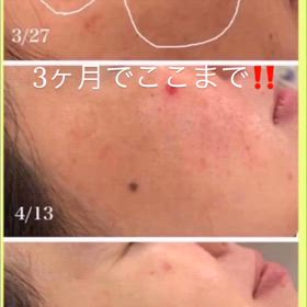 3ヶ月で肝斑うすくの画像