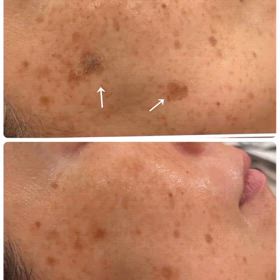 シミ肝斑薄くなってますの画像