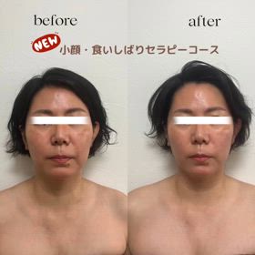 NEWメニュー　「小顔・噛み締めセラピー」の画像