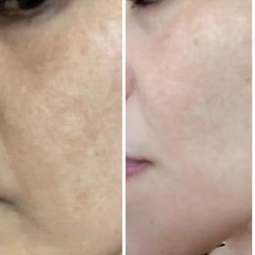 レーザーでも改善できない肝斑の画像