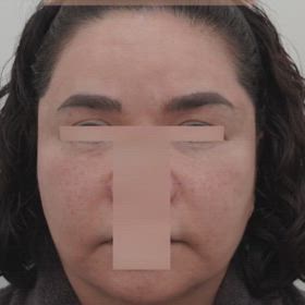 額挙上、ミニリフト、顔脂肪吸引症例動画の画像