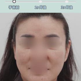 額拳上、額縮小、顔面リフト、エクソソーム、水光注射✎の画像