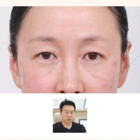 瞼がスッキリ開いて二重復活！の画像