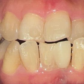 インビザラインも終わりが見えてきましたの画像