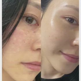 エクソソーム+スキンボトックス（動画付き）の画像