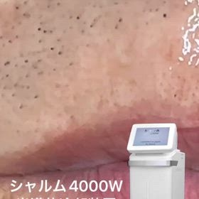 業務用脱毛機シャルムの画像